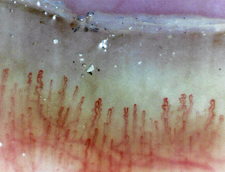 Capillary observation by Bscan-ZD on March 13th 2024