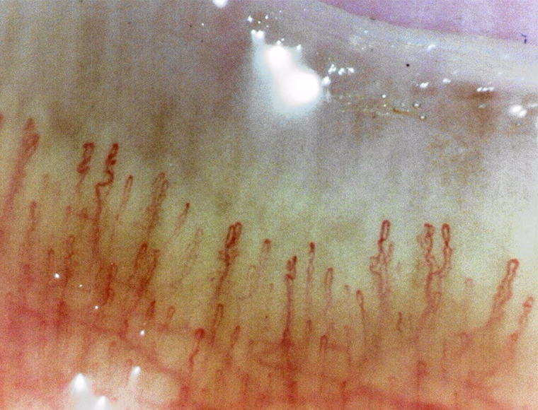 Capillary observation by Bscan-ZD on June 27th 2024