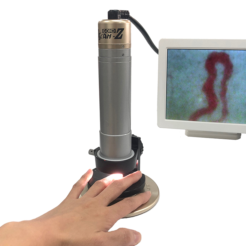 Custom-designed capillaroscope with 1000x magnification