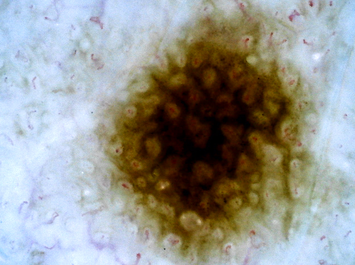Fine mole (approx. 1 mm in diameter)200X, upgraded color reproducibility New version (Ver.1.1)