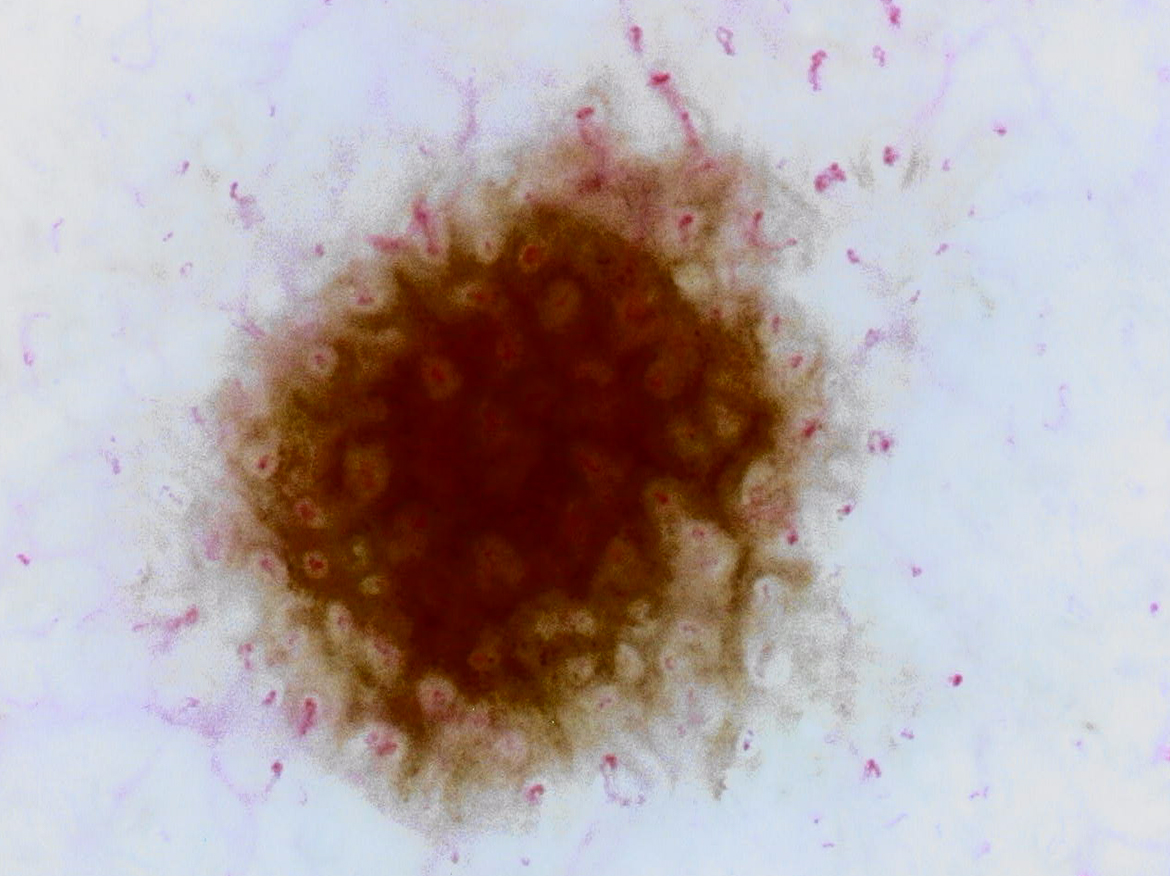 Fine mole (approx. 1 mm in diameter) 175X Previous version