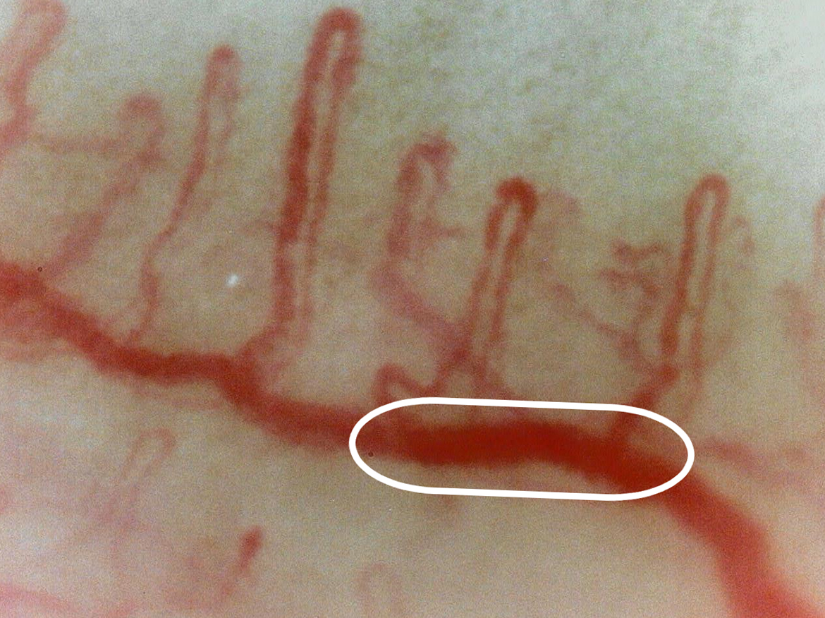 Nailfold capillaries (at higher magnification) 620X Previous version