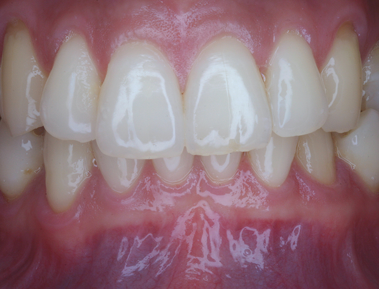 Intraoral mode