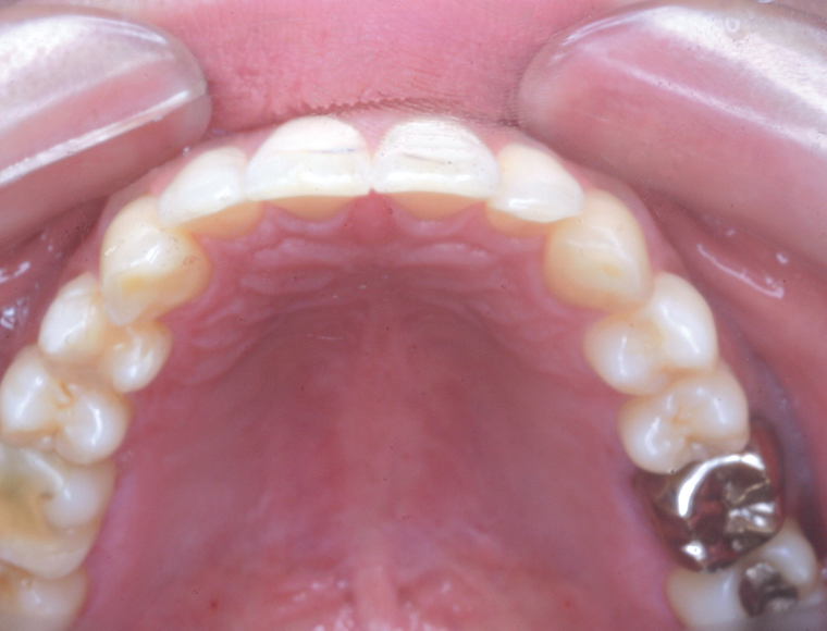 Intraoral mode